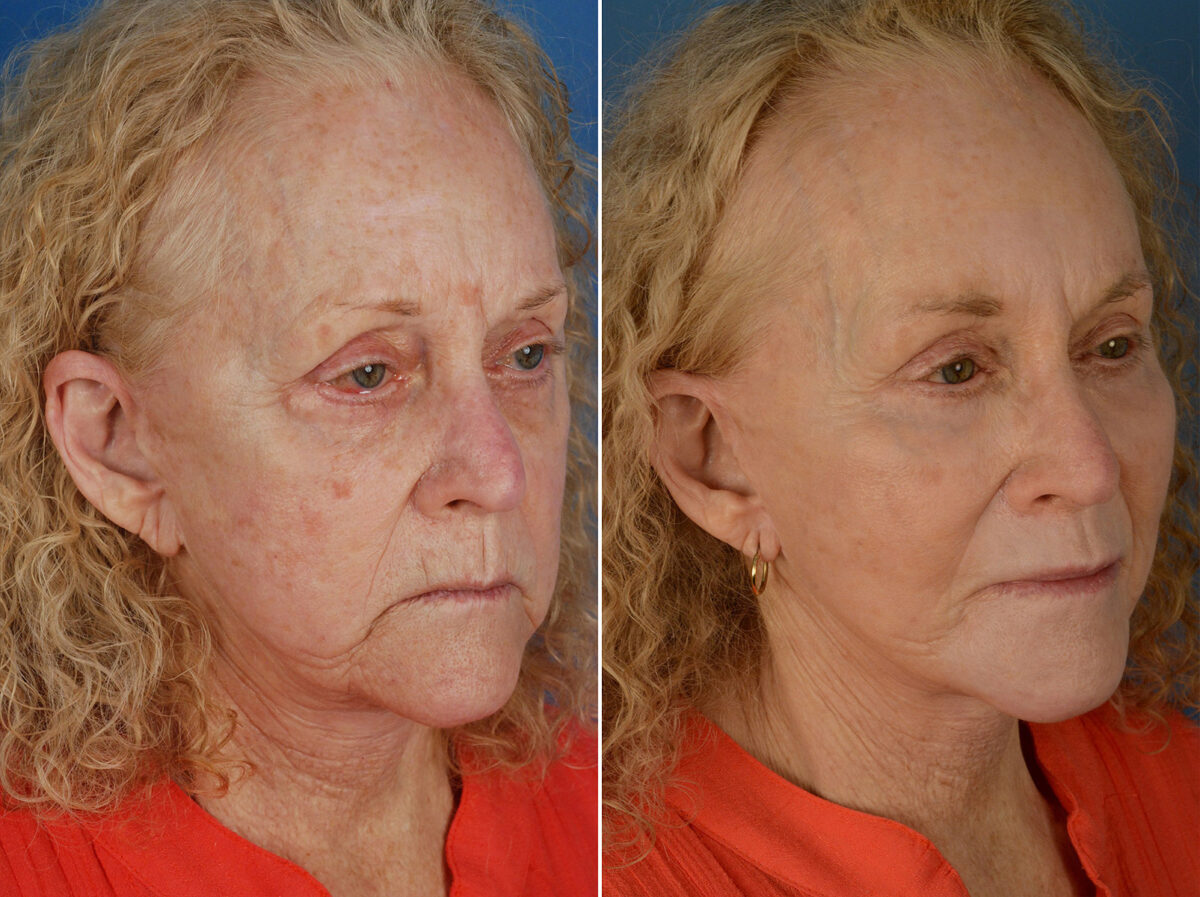 Endoscopic Facelift Before and After Photos in Naples, FL, Patient 12660