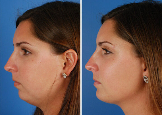 Neck Liposuction Before and After Photos in Naples, FL, Patient 13672