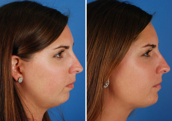 Neck Liposuction Before and After Photos in Naples, FL, Patient 13672