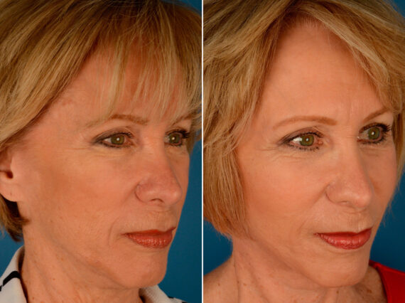 Cheek Implants Before and After Photos in Naples, FL, Patient 14016