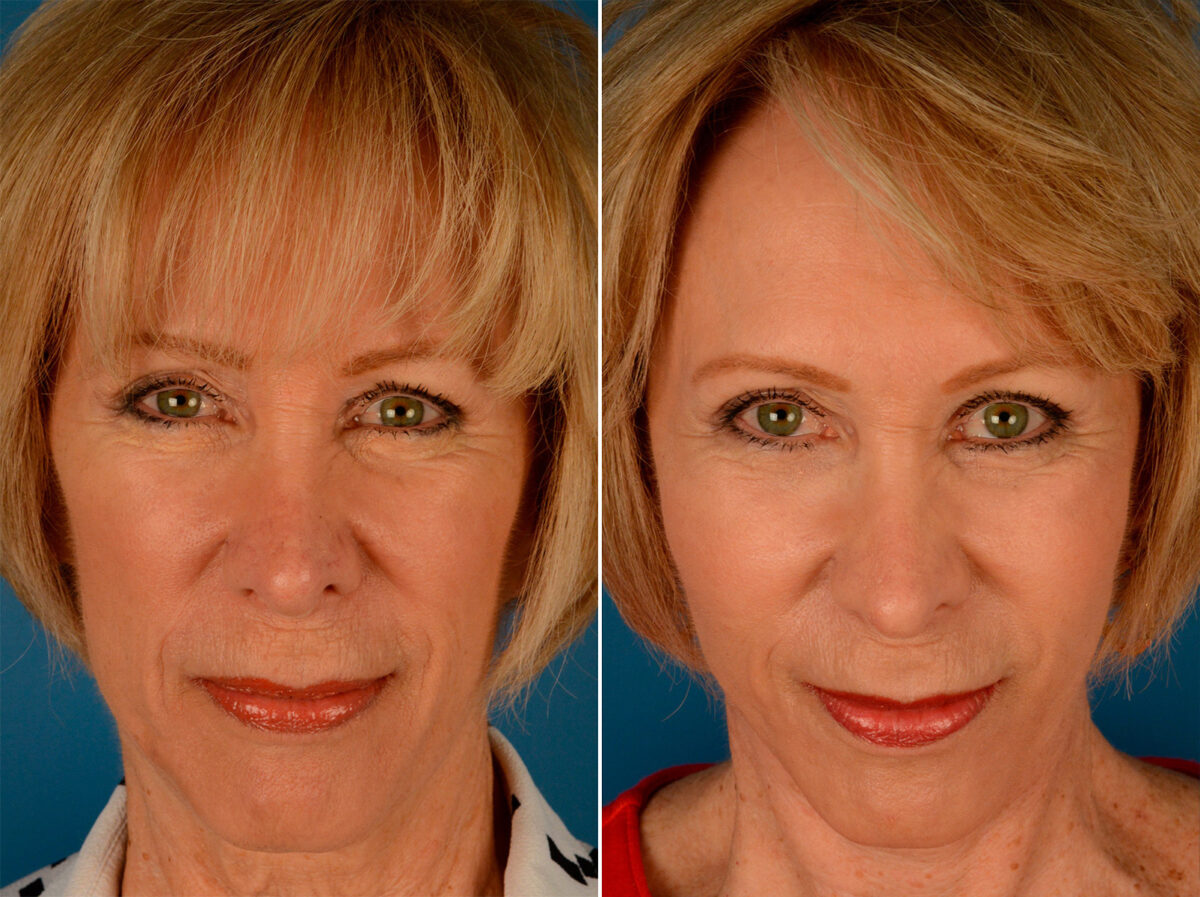 Cheek Implants Before and After Photos in Naples, FL, Patient 14016