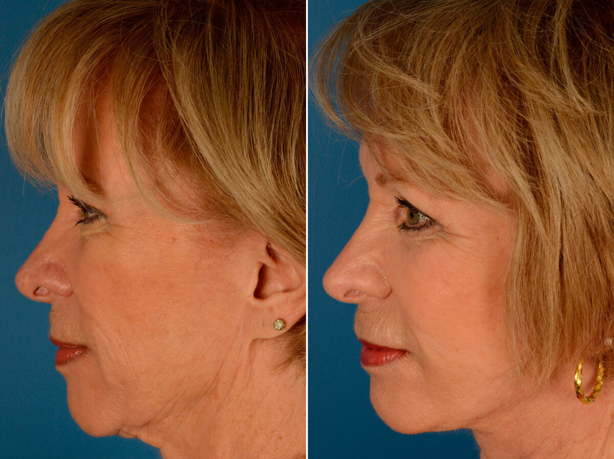 Cheek Implants Before and After Photos in Naples, FL, Patient 14016