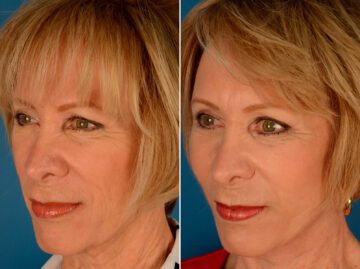 Cheek Implants Before and After Photos in Naples, FL, Patient 14016