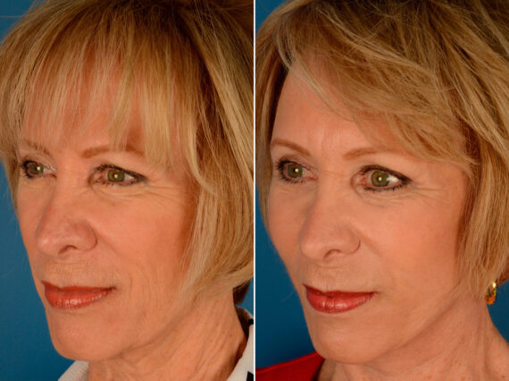 Cheek Implants Before and After Photos in Naples, FL, Patient 14016