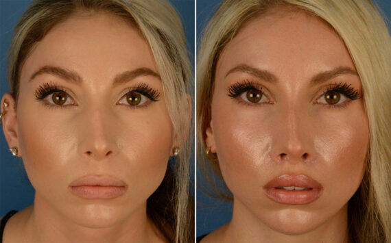 Lip Lift Before and After Photos in Naples, FL, Patient 14912