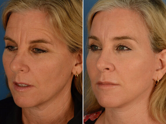 Eyebrow & Forehead Before and After Photos in Naples, FL, Patient 15100