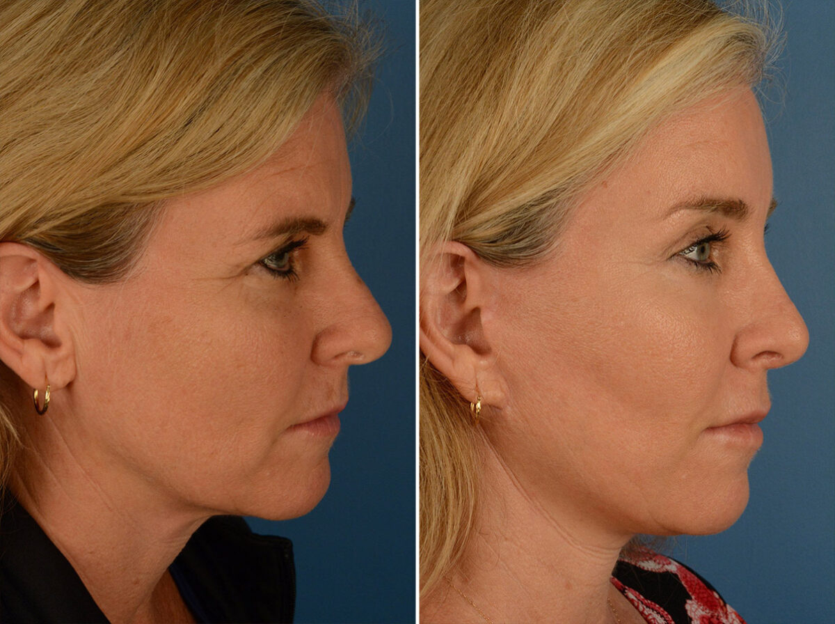 Eyebrow & Forehead Before and After Photos in Naples, FL, Patient 15100