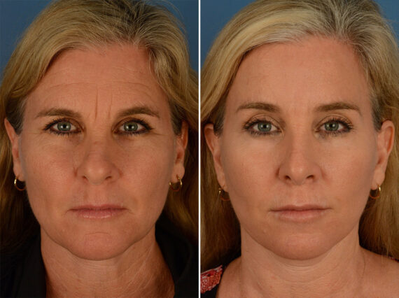 Eyebrow & Forehead Before and After Photos in Naples, FL, Patient 15100