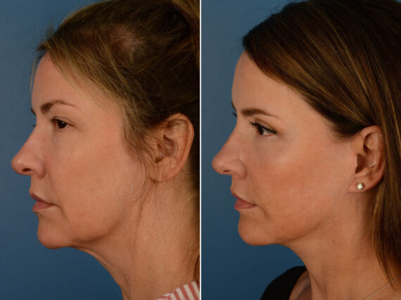 The UpLift™ Lower Face and Neck Lift Before and After Photos in Naples, FL, Patient 15203