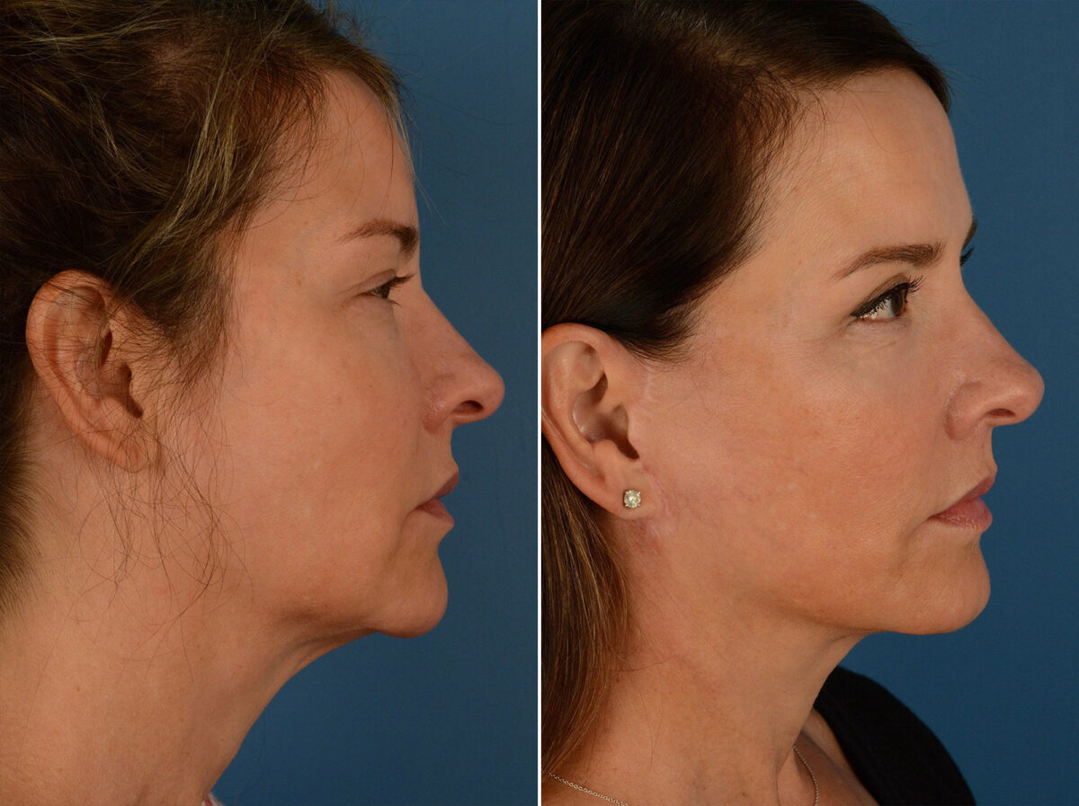The UpLift™ Lower Face and Neck Lift Before and After Photos in Naples, FL, Patient 15203