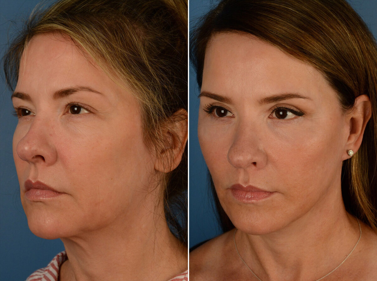 The UpLift™ Lower Face and Neck Lift Before and After Photos in Naples, FL, Patient 15203
