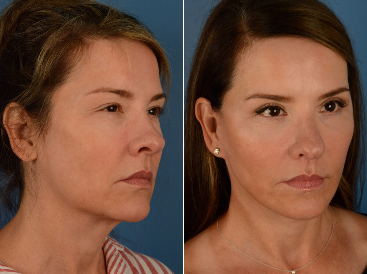 The UpLift™ Lower Face and Neck Lift Before and After Photos in Naples, FL, Patient 15203