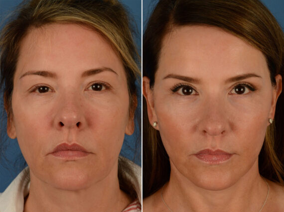 The UpLift™ Lower Face and Neck Lift Before and After Photos in Naples, FL, Patient 15203