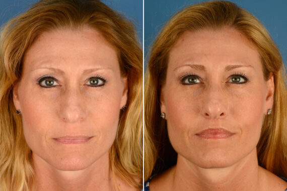 Lip Lift Before and After Photos in Naples, FL, Patient 16408