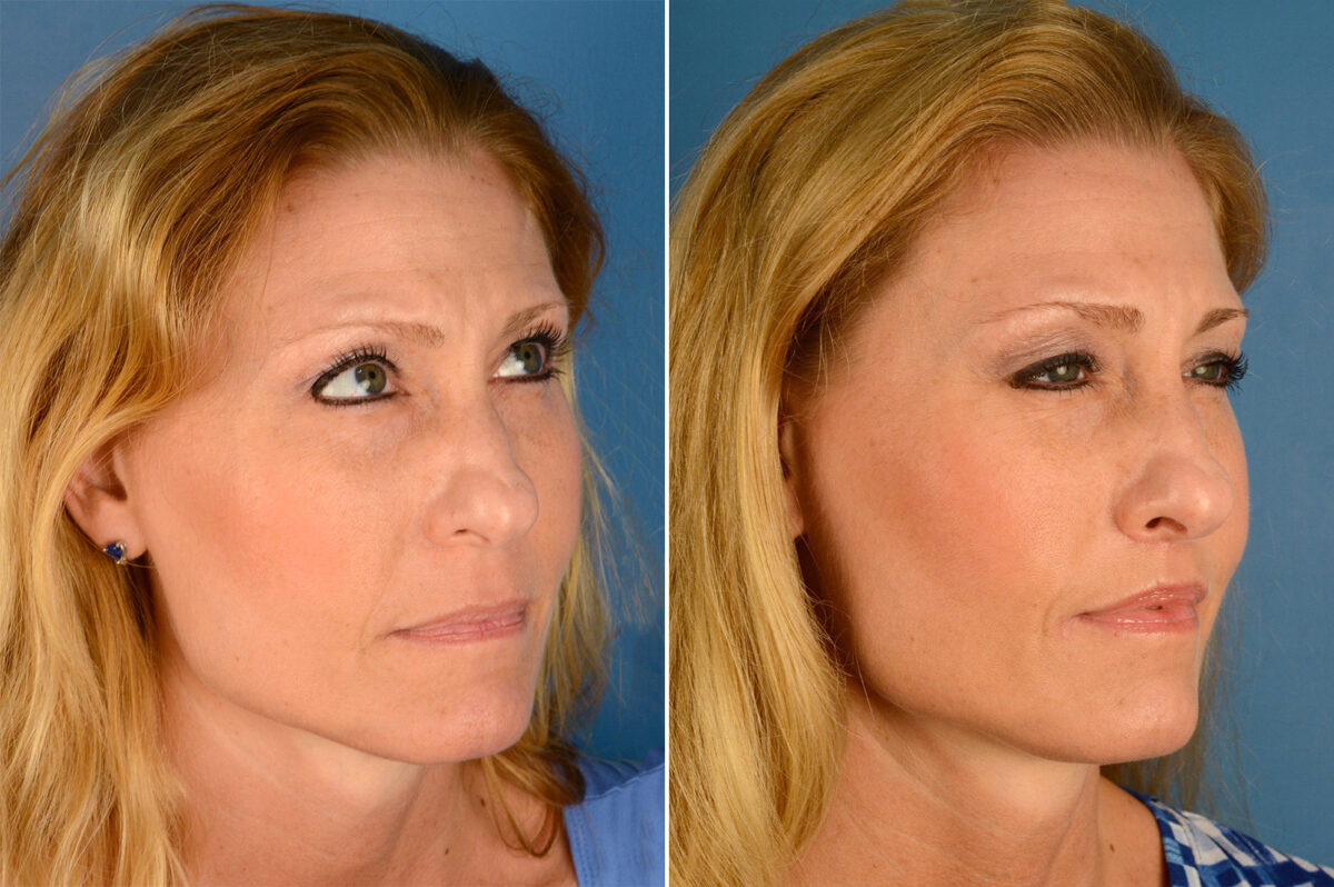 Lip Lift Before and After Photos in Naples, FL, Patient 16408