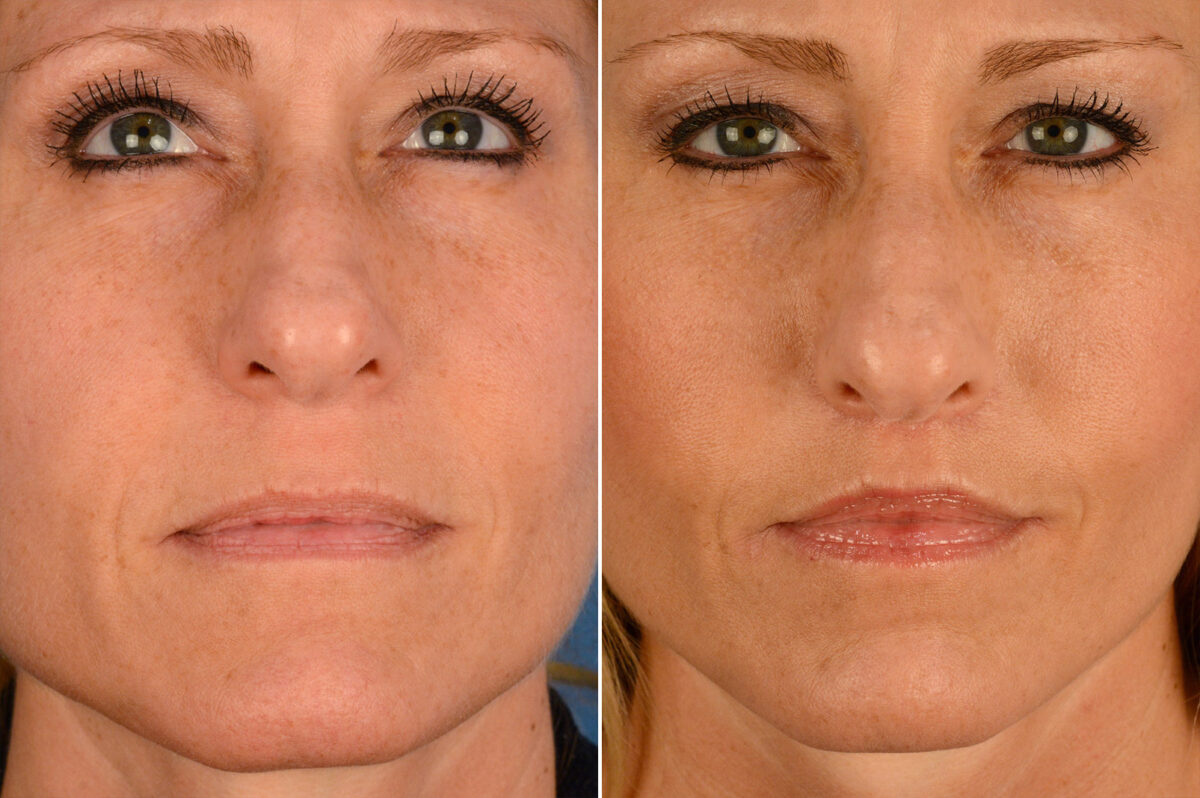 Lip Lift Before and After Photos in Naples, FL, Patient 16408