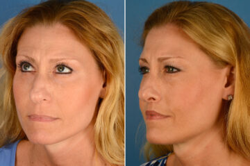 Lip Lift Before and After Photos in Naples, FL, Patient 16408