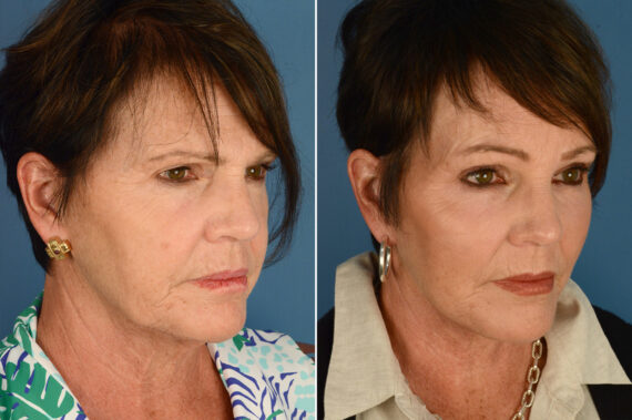 Endoscopic Facelift Before and After Photos in Naples, FL, Patient 18726