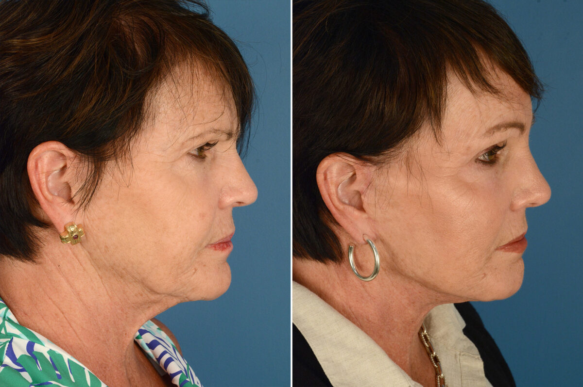 Endoscopic Facelift Before and After Photos in Naples, FL, Patient 18726