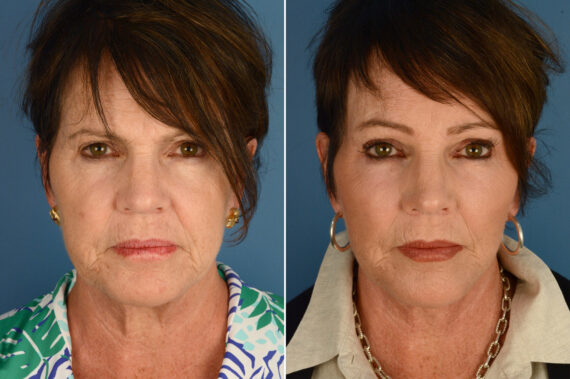 Endoscopic Facelift Before and After Photos in Naples, FL, Patient 18726