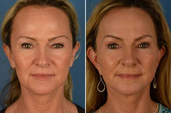 Endoscopic Facelift Before and After Photos in Naples, FL, Patient 19235