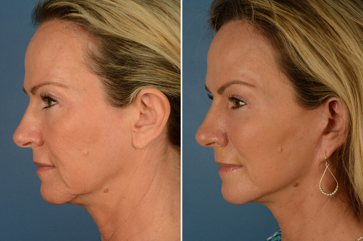 Endoscopic Facelift Before and After Photos in Naples, FL, Patient 19235