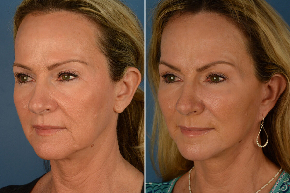 Endoscopic Facelift Before and After Photos in Naples, FL, Patient 19235