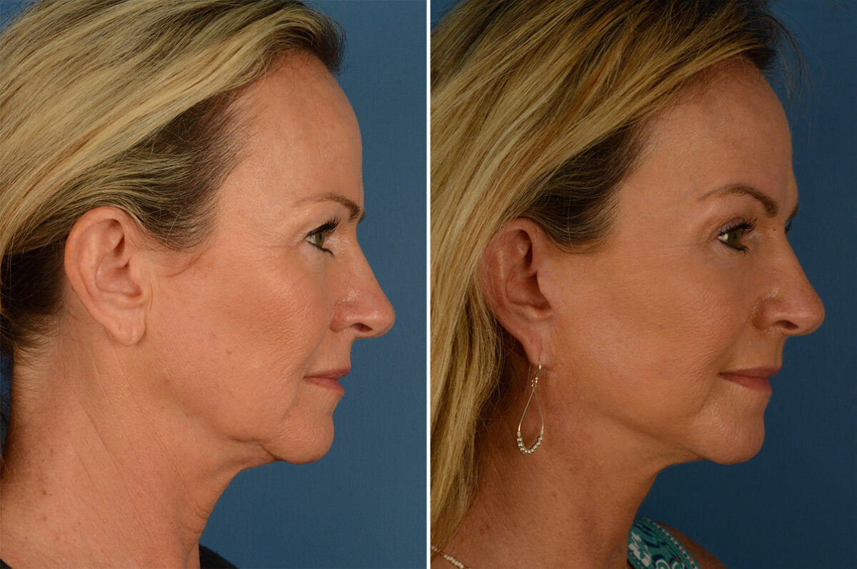 Endoscopic Facelift Before and After Photos in Naples, FL, Patient 19235