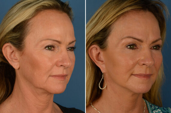 Endoscopic Facelift Before and After Photos in Naples, FL, Patient 19235