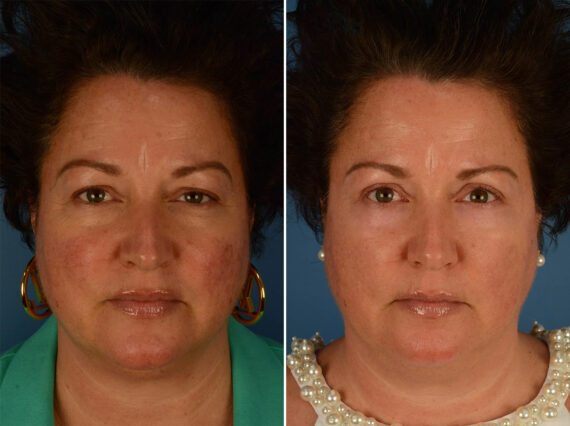 Blepharoplasty Before and After Photos in Naples, FL, Patient 21952