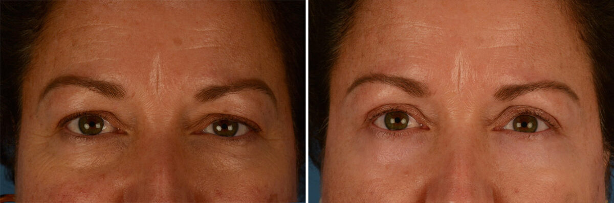 Blepharoplasty Before and After Photos in Naples, FL, Patient 21952