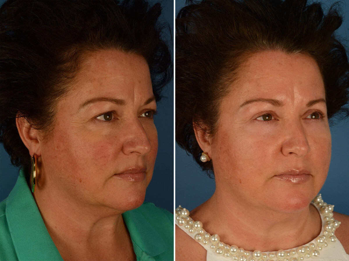 Blepharoplasty Before and After Photos in Naples, FL, Patient 21952