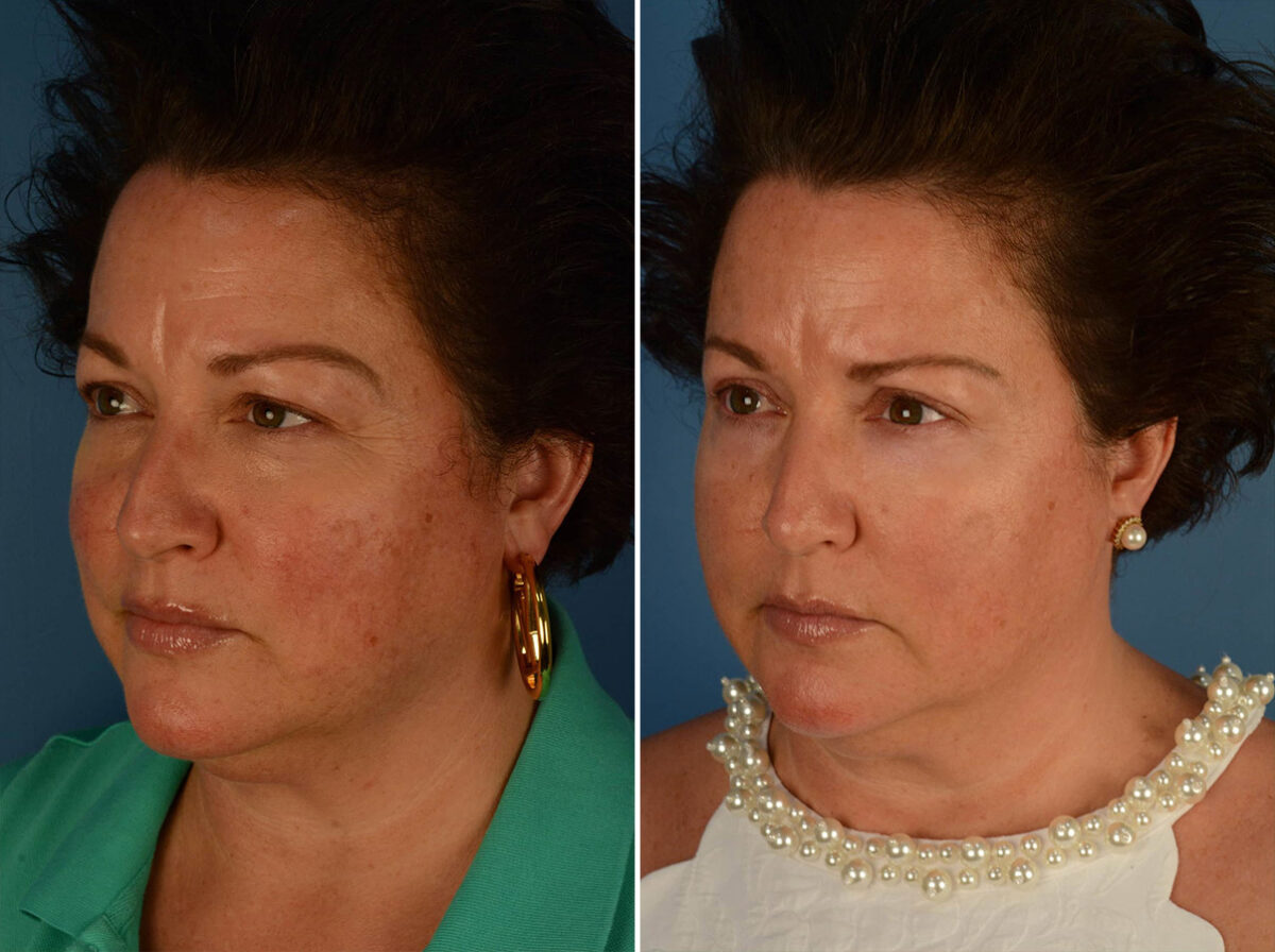 Blepharoplasty Before and After Photos in Naples, FL, Patient 21952