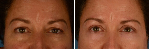 Blepharoplasty Before and After Photos in Naples, FL, Patient 21952