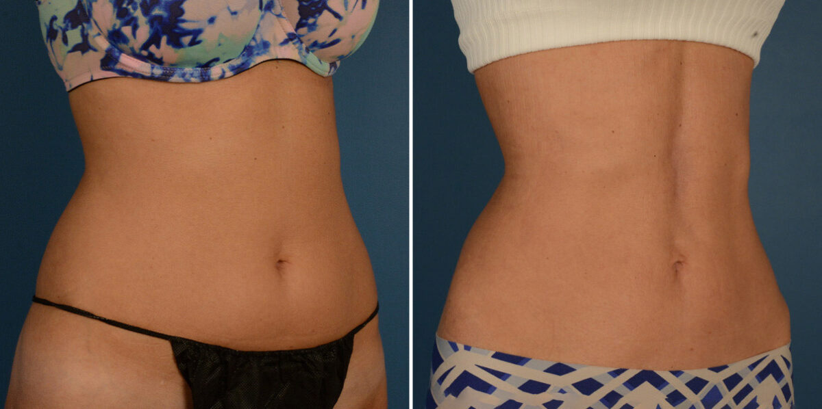 VASER® Liposuction Before and After Photos in Naples, FL, Patient 23209
