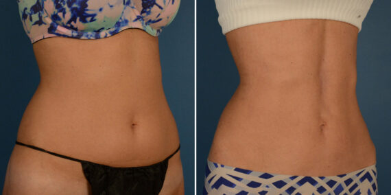 What to Do After Liposuction to Get Best Results, Before and After Photos VASER® Liposuction Before and After Photos in Naples, FL, Patient 23209