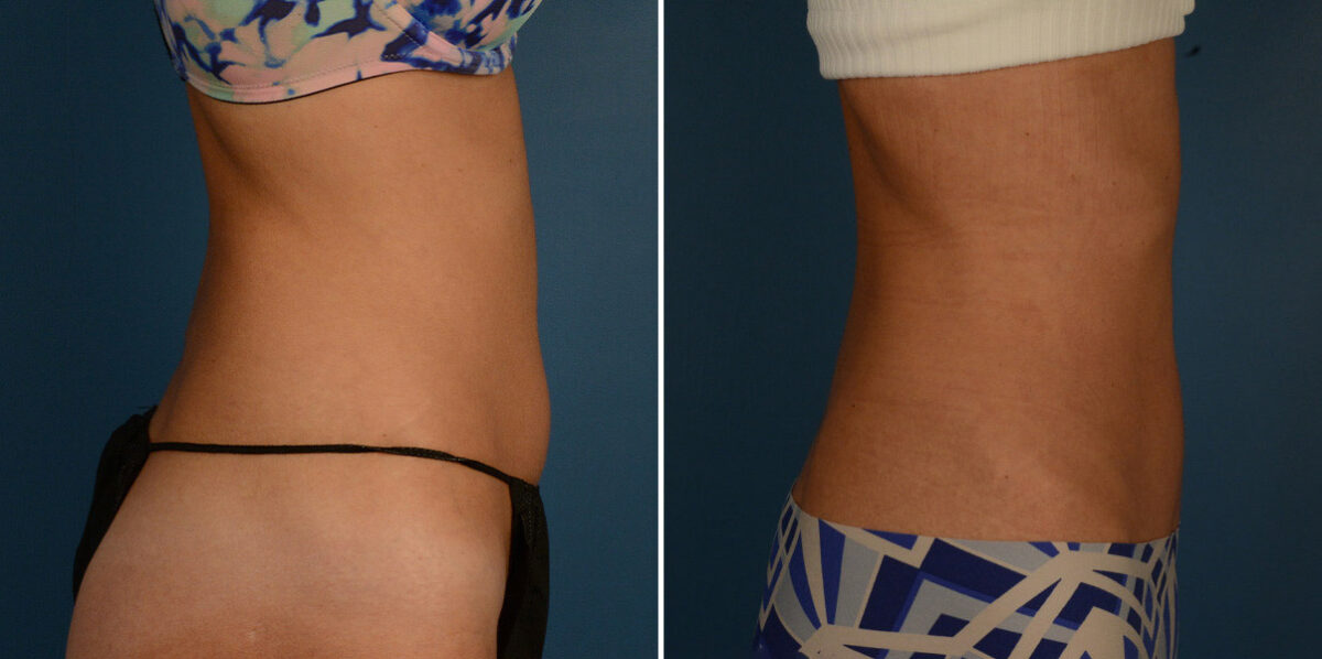 VASER® Liposuction Before and After Photos in Naples, FL, Patient 23209
