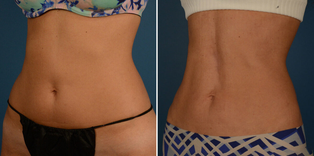 VASER® Liposuction Before and After Photos in Naples, FL, Patient 23209