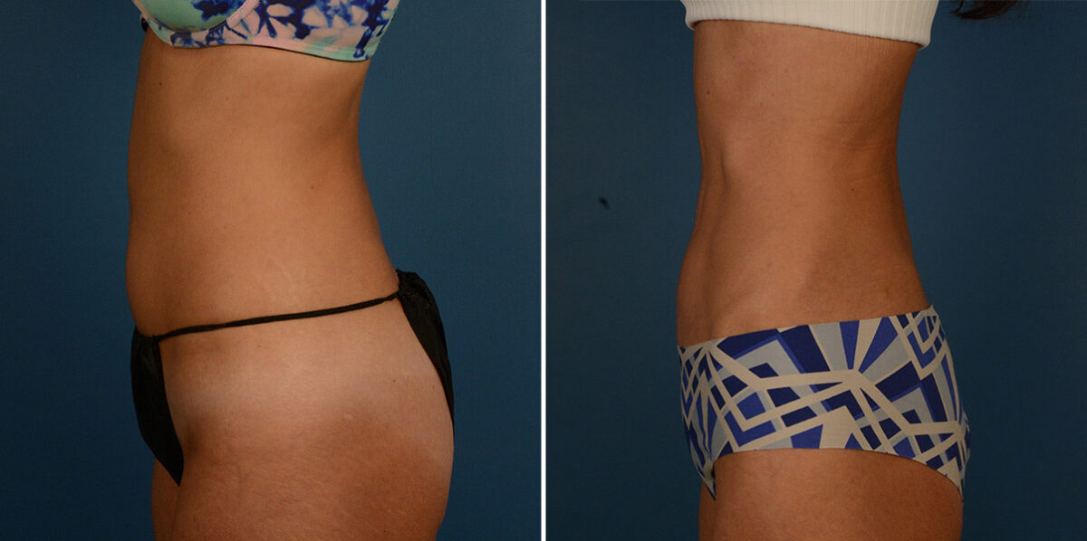 VASER® Liposuction Before and After Photos in Naples, FL, Patient 23209