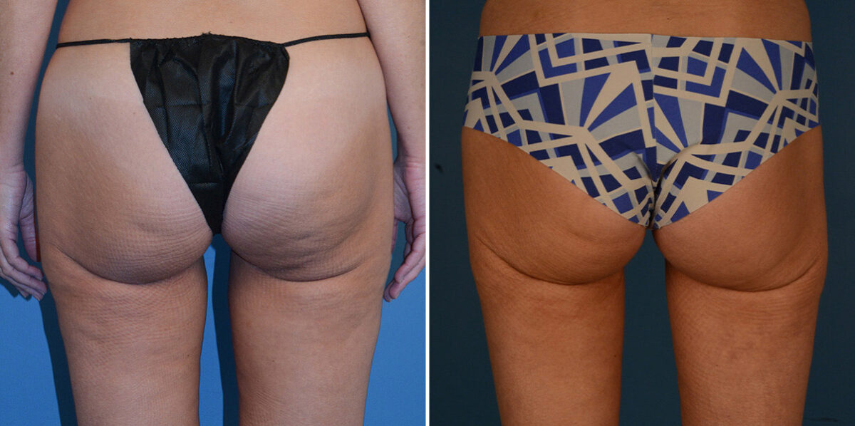 VASER® Liposuction Before and After Photos in Naples, FL, Patient 23209