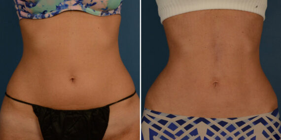What to Do After Liposuction to Get Best Results, Before and After Photos VASER® Liposuction Before and After Photos in Naples, FL, Patient 23209