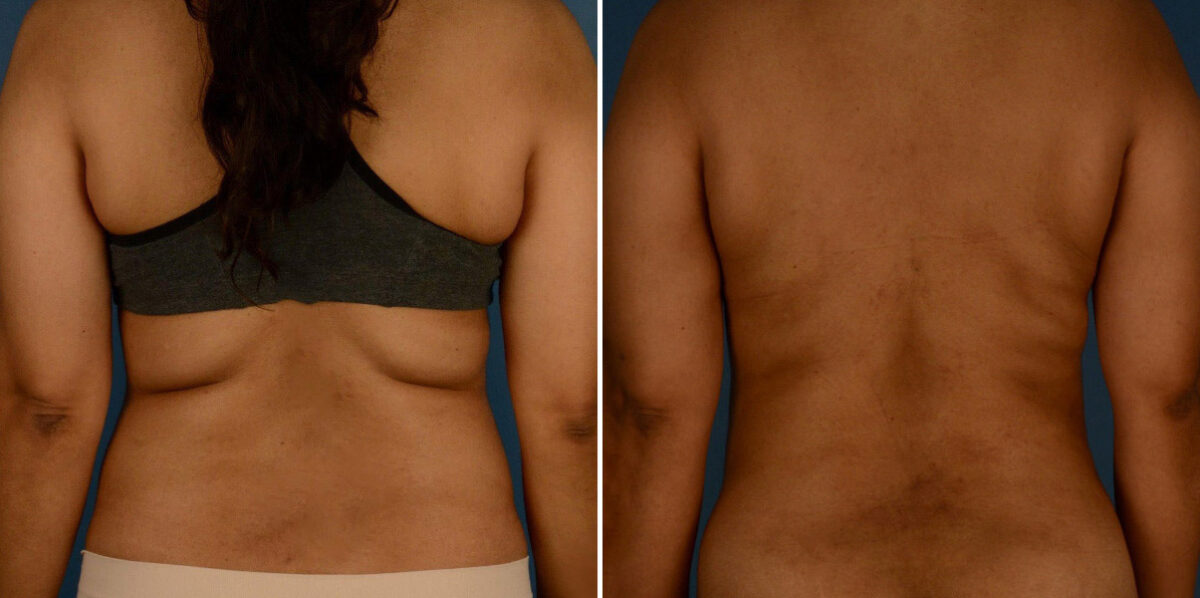 VASER® Liposuction Before and After Photos in Naples, FL, Patient 23241