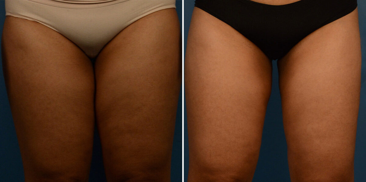 VASER® Liposuction Before and After Photos in Naples, FL, Patient 23241