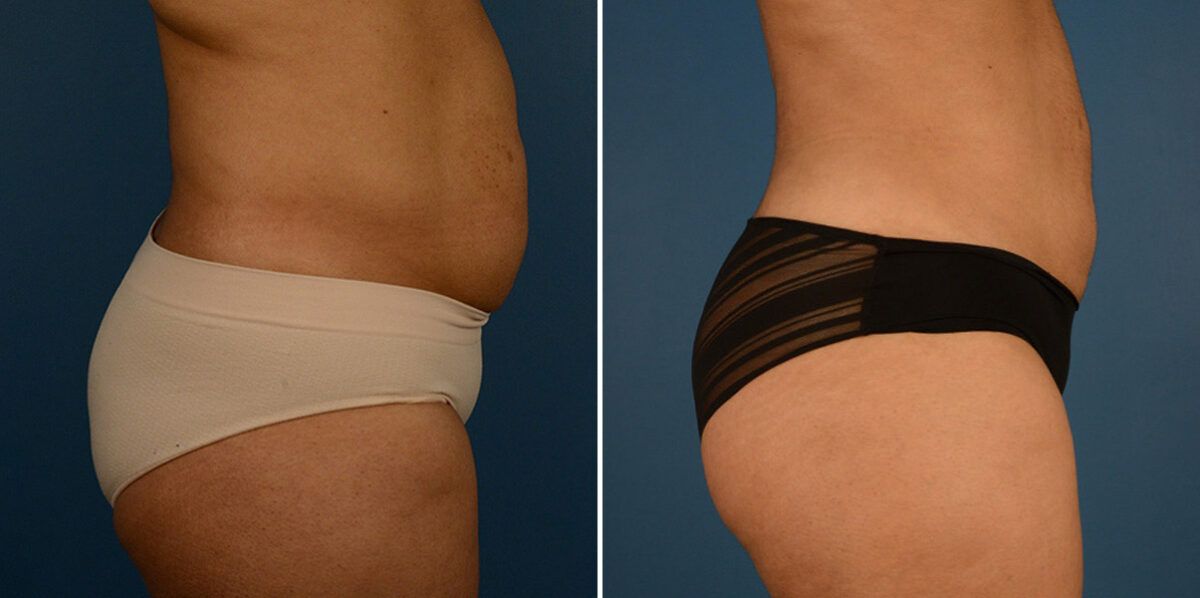 VASER® Liposuction Before and After Photos in Naples, FL, Patient 23241