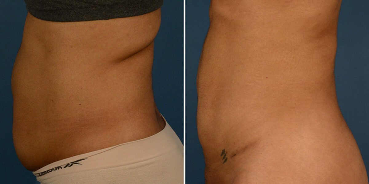 VASER® Liposuction Before and After Photos in Naples, FL, Patient 23241
