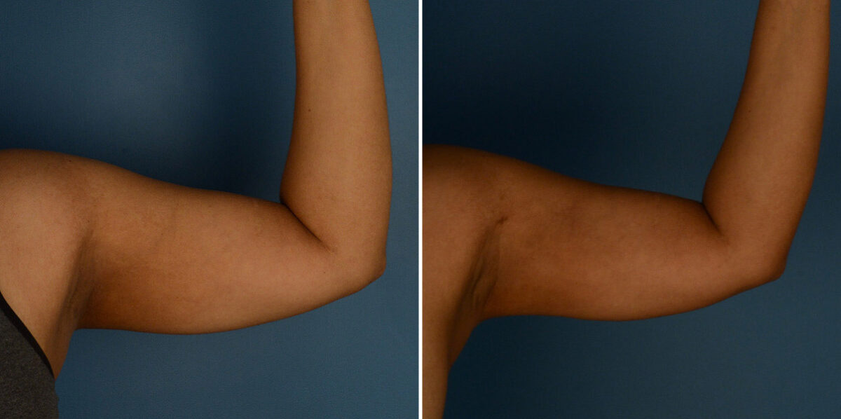 VASER® Liposuction Before and After Photos in Naples, FL, Patient 23241