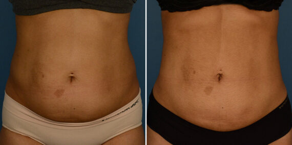 VASER® Liposuction Before and After Photos in Naples, FL, Patient 23241