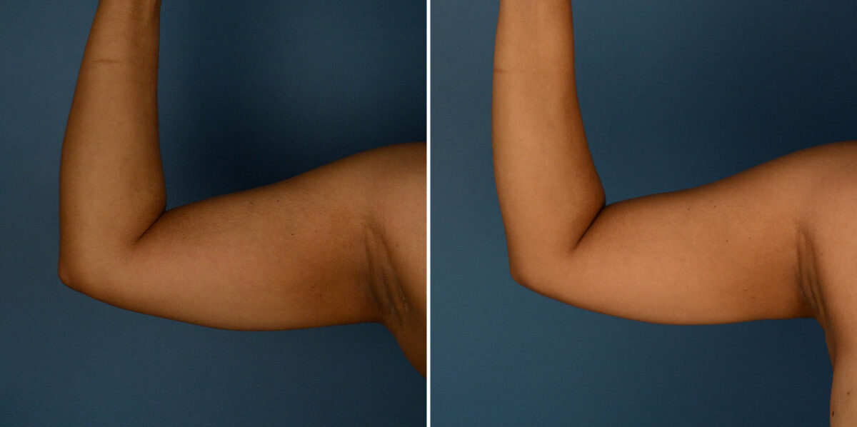 VASER® Liposuction Before and After Photos in Naples, FL, Patient 23241