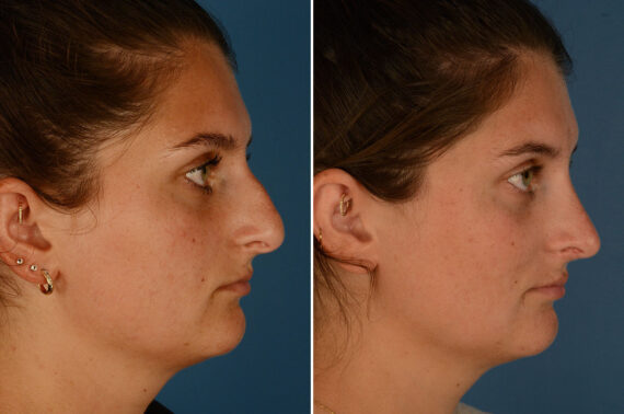 Rhinoplasty Before and After Photos in Naples, FL, Patient 24737