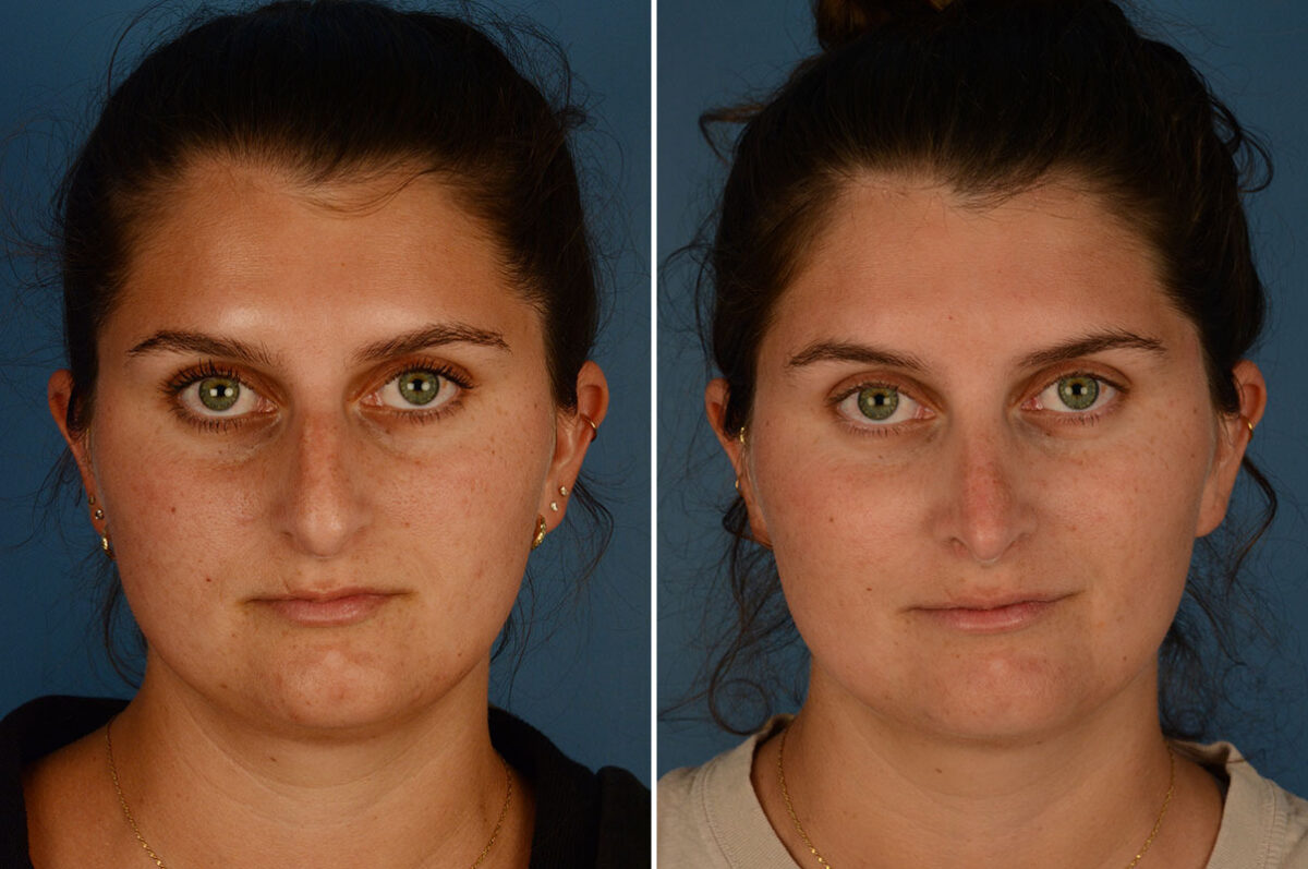 Rhinoplasty Before and After Photos in Naples, FL, Patient 24737
